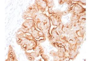 Formalin-fixed, paraffin-embedded human Ovarian Carcinoma stained with MUC16 Mouse Monoclonal Antibody (MUC16/1860). (MUC16 antibody)