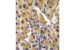 immunohistochemistry analysis in formalin fixed and paraffin embedded human hepatocarcinoma followed by peroxidase conjugation of the secondary antibody and DAB staining. (ENPP2 antibody  (AA 401-430))