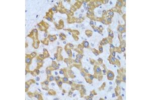 Immunohistochemistry of paraffin-embedded human liver cancer using PRKCD antibody. (PKC delta antibody  (AA 477-676))