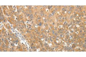 Immunohistochemistry of paraffin-embedded Human ovarian cancer using AKR1B1 Polyclonal Antibody at dilution of 1:30 (AKR1B1 antibody)
