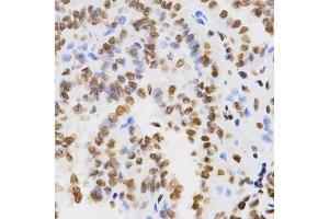 Immunohistochemistry of paraffin-embedded human thyroid cancer using DiMethyl-Histone H3-K9 antibody (ABIN1872998) at dilution of 1:200 (40x lens). (Histone 3 antibody  (H3K9me2))