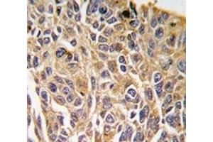 IHC analysis of FFPE human lung carcinoma tissue stained with RIPK3 antibody (RIPK3 antibody  (AA 1-30))