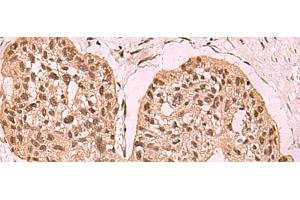 Immunohistochemistry of paraffin-embedded Human esophagus cancer tissue using SETDB1 Polyclonal Antibody at dilution of 1:60(x200) (SETDB1 antibody)