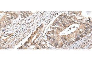 Immunohistochemistry of paraffin-embedded Human colorectal cancer tissue using ATF6B Polyclonal Antibody at dilution of 1:30(x200) (ATF6B antibody)