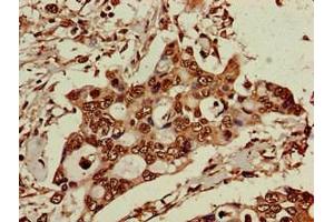 Immunohistochemistry of paraffin-embedded human pancreatic cancer using ABIN7151588 at dilution of 1:100 (ELP6 antibody  (AA 95-195))