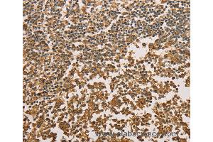 Immunohistochemistry of Human cervical cancer using SETD2 Polyclonal Antibody at dilution of 1:40