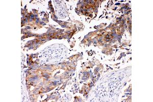 Anti-SLC16A4 antibody, IHC(P) IHC(P): Human Mammary Cancer Tissue (SLC16A4 antibody  (N-Term))