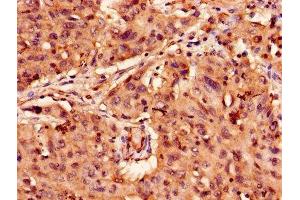 Immunohistochemistry of paraffin-embedded human lung cancer using ABIN7144485 at dilution of 1:100 (APAF1 antibody  (AA 104-415))