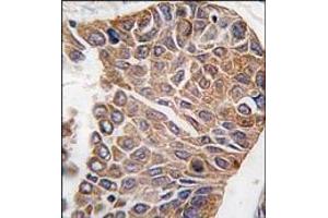 Formalin-fixed and paraffin-embedded human lung carcinoma tissue reacted with AKT2 antibody (C-term), which was peroxidase-conjugated to the secondary antibody, followed by DAB staining. (AKT2 antibody  (C-Term))