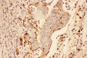 Anti-MMP7 Picoband antibody,  IHC(P): Human Intestinal Cancer Tissue (MMP7 antibody  (AA 1-267))
