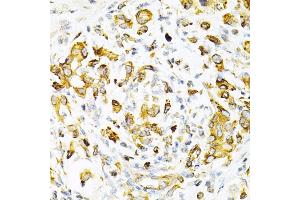 Immunohistochemistry of paraffin-embedded human gastric cancer using TAPBP Antibody (ABIN6132745, ABIN6148848, ABIN6148850 and ABIN6219122) at dilution of 1:200 (40x lens). (TAPBP antibody  (AA 30-260))