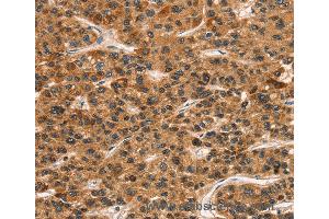 Immunohistochemistry of Human gastric cancer using KLRC1 Polyclonal Antibody at dilution of 1:30 (CD159a/c antibody)