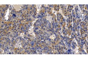 Detection of PGLYRP1 in Human Liver cancer Tissue using Polyclonal Antibody to Peptidoglycan Recognition Protein 1 (PGLYRP1) (PGLYRP1 antibody  (AA 22-196))