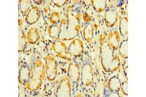Immunohistochemistry of paraffin-embedded human gastric cancer using ABIN7175053 at dilution of 1:100 (KIAA1324-Like antibody  (AA 227-526))