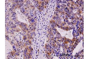 Immunoperoxidase of monoclonal antibody to TYMS on formalin-fixed paraffin-embedded human stomach carcinoma. (TYMS antibody  (AA 111-210))