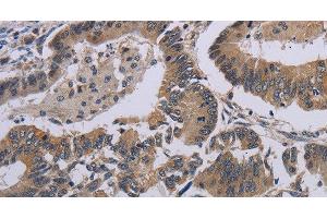 Immunohistochemistry of paraffin-embedded Human colon cancer tissue using CCL1 Polyclonal Antibody at dilution 1:50 (CCL1 antibody)