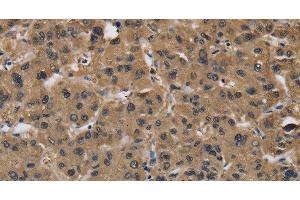 Immunohistochemistry of paraffin-embedded Human liver cancer using FABP2 Polyclonal Antibody at dilution of 1:40 (FABP2 antibody)