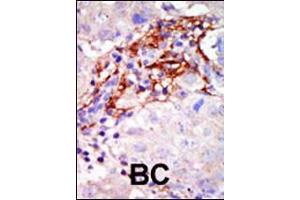 Formalin-fixed and paraffin-embedded human cancer tissue reacted with the primary antibody, which was peroxidase-conjugated to the secondary antibody, followed by AEC staining. (MAP2K3 antibody  (N-Term))