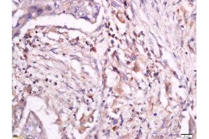 Formalin-fixed and paraffin embedded human lung carcinoma labeled with Anti-CD18 (Thr758) Polyclonal Antibody, Unconjugated  at 1:200 followed by conjugation to the secondary antibody and DAB staining. (Integrin beta 2 antibody  (pThr758))