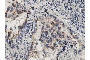 Immunohistochemical staining of paraffin-embedded Carcinoma of Human lung tissue using anti-LACTB2 mouse monoclonal antibody. (LACTB2 antibody)