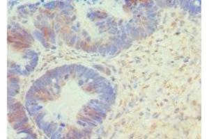 Immunohistochemistry of paraffin-embedded human ovarian cancer using ABIN7145167 at dilution of 1:100 (Cyclin D1 antibody  (AA 1-233))
