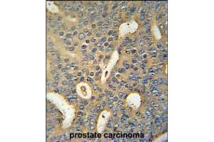MICALL1 Antibody immunohistochemistry analysis in formalin fixed and paraffin embedded human prostate carcinoma followed by peroxidase conjugation of the secondary antibody and DAB staining. (MICAL-Like 1 antibody  (C-Term))