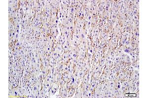 Formalin-fixed and paraffin embedded human hepatoma labeled with Anti-Hyaluronidase-PH20/Haase Polyclonal Antibody, Unconjugated (ABIN673779) followed by conjugation to the secondary antibody and DAB staining (HYAL1 antibody  (AA 271-400))
