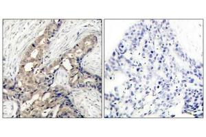 Immunohistochemical analysis of paraffin-embedded human breast carcinoma tissue using c-Abl (phospho-Tyr412) antibody. (ABL1 antibody  (pTyr412))