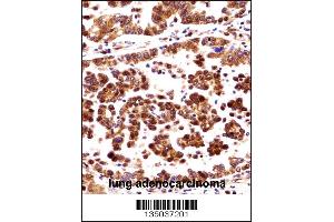 ORC3L Antibody immunohistochemistry analysis in formalin fixed and paraffin embedded human lung adenocarcinoma followed by peroxidase conjugation of the secondary antibody and DAB staining. (ORC3 antibody  (N-Term))