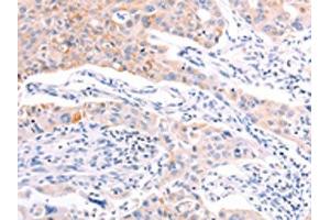 The image on the left is immunohistochemistry of paraffin-embedded Human lung cancer tissue using ABIN7192139(RalA Antibody) at dilution 1/20, on the right is treated with synthetic peptide. (rala antibody)