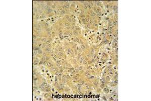 CYP2A7 antibody immunohistochemistry analysis in formalin fixed and paraffin embedded human hepatocarcinoma followed by peroxidase conjugation of the secondary antibody and DAB staining. (CYP2A7 antibody  (AA 121-148))