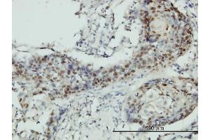 Immunoperoxidase of monoclonal antibody to RNMT on formalin-fixed paraffin-embedded human squamous cell carcinoma tissue. (RNMT antibody  (AA 1-476))