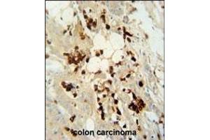 WDR21C antibody (N-term) (ABIN654576 and ABIN2844279) immunohistochemistry analysis in formalin fixed and paraffin embedded human colon carcinoma followed by peroxidase conjugation of the secondary antibody and DAB staining. (DCAF4L2 antibody  (N-Term))