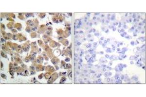 Immunohistochemistry analysis of paraffin-embedded human breast carcinoma tissue, using TGF beta1 Antibody. (TGFB1 antibody  (AA 336-385))