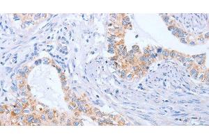 Immunohistochemistry of paraffin-embedded Human cervical cancer tissue using BST1 Polyclonal Antibody at dilution 1:50 (BST1 antibody)