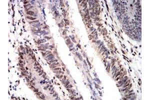 Immunohistochemical analysis of paraffin-embedded rectum cancer tissues using CIRBP mouse mAb with DAB staining.