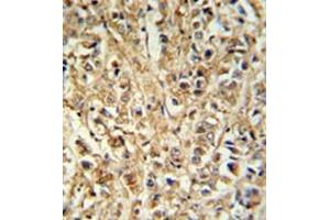 Formalin fixed, paraffin embedded breast carcinoma reacted with DDX6 Antibody (Center) followed by peroxidase conjugation of the secondary antibody and DAB staining. (DDX6 antibody  (Middle Region))