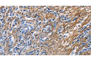 Immunohistochemistry of paraffin-embedded Human prostate cancer tissue using COL3A1 Polyclonal Antibody at dilution 1:60 (COL3A1 antibody)