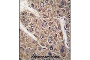 Formalin-fixed and paraffin-embedded human hepatocarcinoma tissue reacted with BICD2 antibody (C-term) (ABIN392178 and ABIN2841891) , which was peroxidase-conjugated to the secondary antibody, followed by DAB staining. (BICD2 antibody  (C-Term))