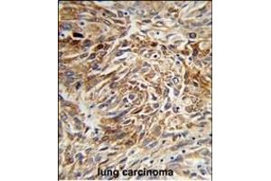 Formalin-fixed and paraffin-embedded human lung carcinoma reacted with AGR3 Antibody (C-term), which was peroxidase-conjugated to the secondary antibody, followed by DAB staining. (AGR3 antibody  (C-Term))