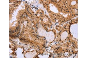 Immunohistochemistry of Human thyroid cancer using EPDR1 Polyclonal Antibody at dilution of 1:40 (EPDR1 antibody)