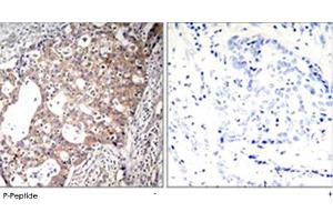 Immunohistochemical analysis of paraffin-embedded human breast carcinoma tissue using SHC1 (phospho Y427) polyclonal antibody . (SHC1 antibody  (pTyr427))