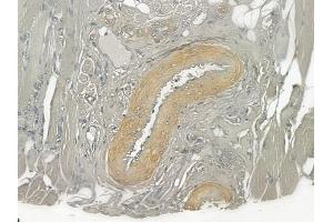 ABIN6258372 and ABIN6275122 at 1/100 staining human tongue carcinoma by IHC-P.