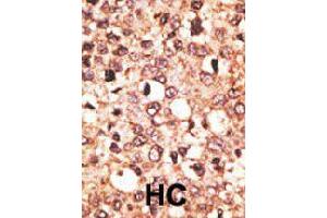 Formalin-fixed and paraffin-embedded human hepatocellular carcinoma tissue reacted with CRY1 polyclonal antibody  , which was peroxidase-conjugated to the secondary antibody, followed by AEC staining. (CRY1 antibody  (C-Term))