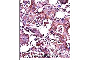 LGALS3 Antibody (C-term) ((ABIN657647 and ABIN2846642))immunohistochemistry analysis in formalin fixed and paraffin embedded human colon carcinoma followed by peroxidase conjugation of the secondary antibody and DAB staining. (Galectin 3 antibody  (C-Term))