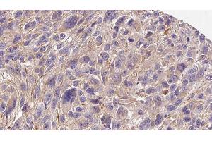 ABIN6272278 at 1/100 staining Human Melanoma tissue by IHC-P. (COL4a6 antibody  (Internal Region))