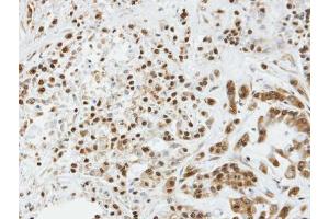 IHC-P Image Immunohistochemical analysis of paraffin-embedded A549 xenograft, using SOCS3, antibody at 1:100 dilution. (SOCS3 antibody  (C-Term))