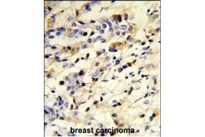 Formalin-fixed and paraffin-embedded human breast carcinoma reacted with IGHM Antibody (N-term), which was peroxidase-conjugated to the secondary antibody, followed by DAB staining. (IGHM antibody  (N-Term))