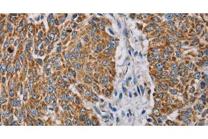 Immunohistochemistry of paraffin-embedded Human lung cancer using MTFP1 Polyclonal Antibody at dilution of 1:30 (Mtfp1 antibody)