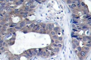 Immunohistochemistry (IHC) analyzes of IRS-1 antibdoy in paraffin-embedded human breast carcinoma tissue. (IRS1 antibody)